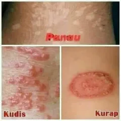 Kurap In English Englshploa