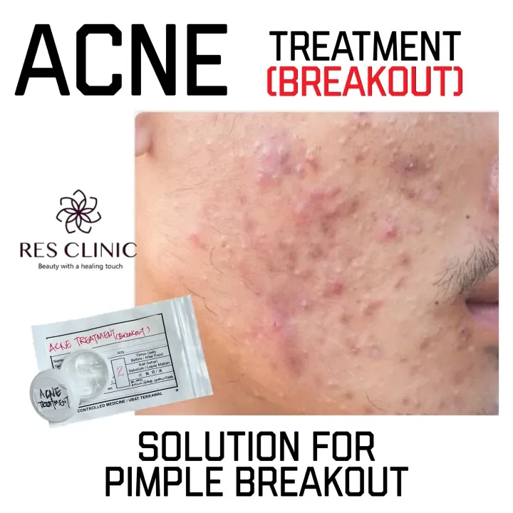 Res Clinic Krim Ubat Jerawat Pimples Acne Treatment Gel Anti Breakouts Anti Bacterials Gel 5g 10g Klinik Pakar Kulit Skincare Lazada